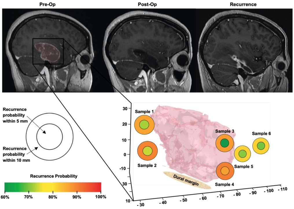 AI predicts where glioblastoma will come back: optical microscopy predictions of focal recurrence