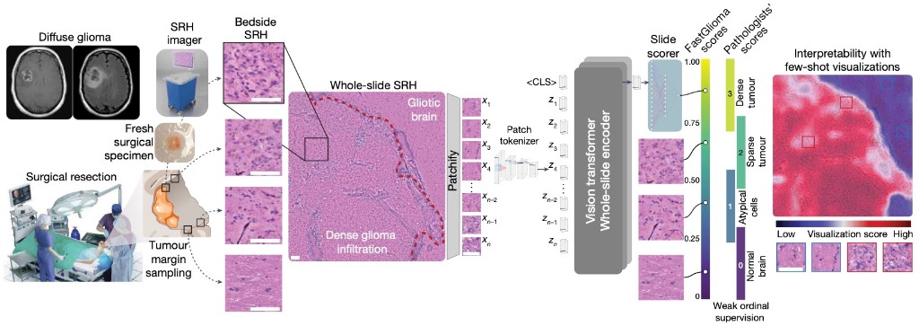 Workflow from diffuse glioma imaging and surgical resection through bedside SRH, whole-slide encoding with a vision transformer, FastGlioma scoring with weak ordinal supervision, and interpretability heatmaps.